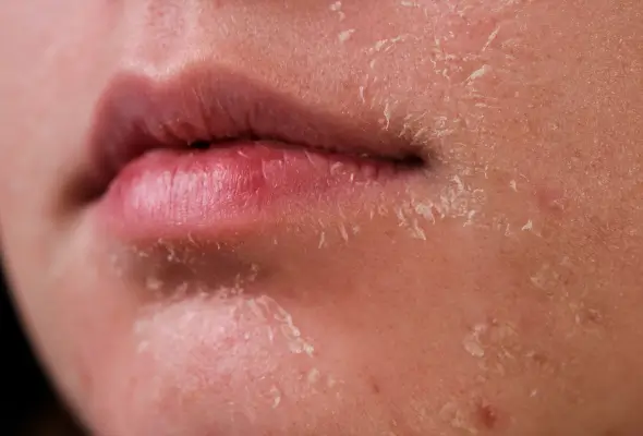 جفاف البشرة.. أزمة تجميلية يمكن السيطرة عليها