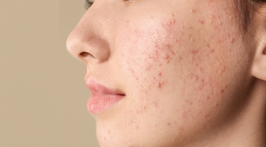 مشاكل البشرة الشائعة في مرحلة المراهقة 