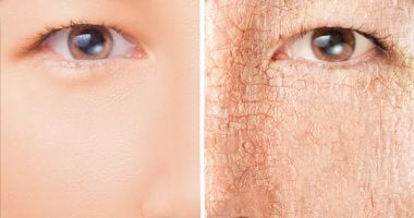 <strong>جفاف البشرة في فصل الشتاء: الأسباب والعلاج ونصائح للحفاظ على نضارتك</strong>