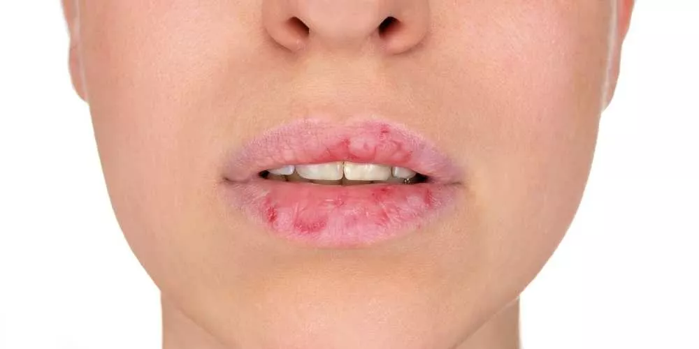 <strong>تشقق الشفاه في فصل الشتاء: الأسباب الحقيقية وطرق العلاج والوقاية</strong>