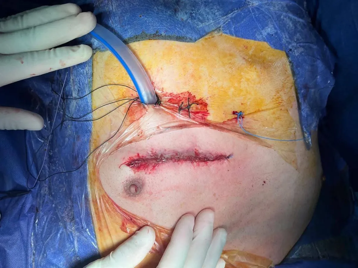 التدخل اىمحدود في جراحة القلب المفتوح