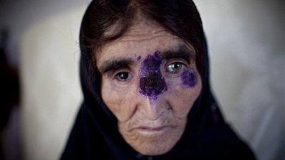 حشرة استوائية تسبب تشوهات في سوريا بسبب 