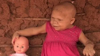 ماريا أوديتي.. برازيلية عمرها 30 عام وتعيش بجسد طفلة