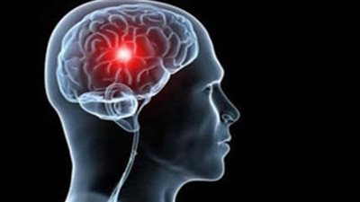 مؤتمر فرنسي للتأكد من الوفاة بالسكتة الدماغية