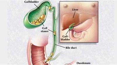 7 أعراض خفية لسرطان المرارة