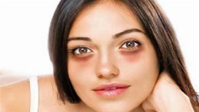  4 نصائح للقضاء على الأكياس الدهنية تحت العينين