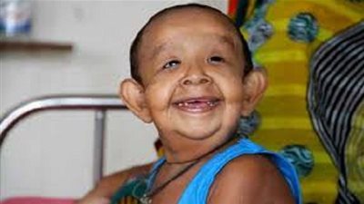 مرض غريب يجعل طفلاً في بنغلادش أشبه بالمسنين 