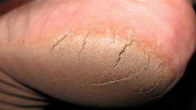  6 طرق لعلاج تشققات القدمين .. تعرفوا عليها 