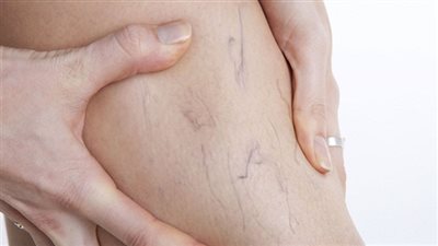 علاج تقليدي للتخلص من الدوالي