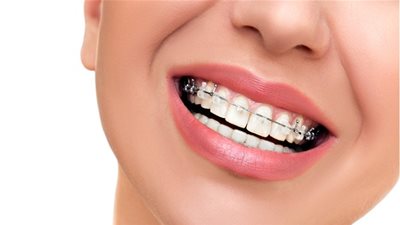 8 معلومات هامة يجب ان تعرفيها عن تقويم الأسنان