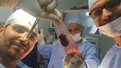 جراحة إستئصال غدة درقية ناجحة بدون فتح بالرقبة بجامعة المنصورة