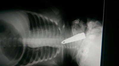 فريق طبي بالمستشفى العام ينقذ طفلة ابتعلت قصاصة أظافر