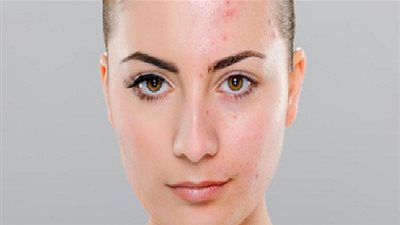  وصفة طبيعية فعالة للتخلص من حب الشباب 