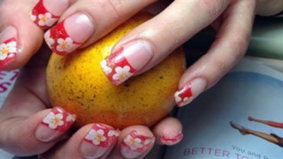 البقع البيضاء بالأظافر من أهم علامات الإصابة بالفشل الكلوى