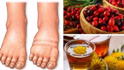 بدون أدوية.. تعرفى على علاج تورم الأقدام واليدين