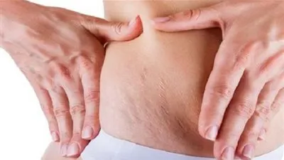 علاج طبيعي للتخلص من السيلوليت نهائيًا