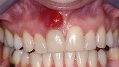 وصفات سحرية لعلاج تورم اللثة 