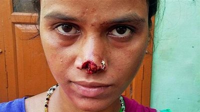 رجل هندي يقطع أنف زوجته ويهرب به .. لسبب غريب! (صور)