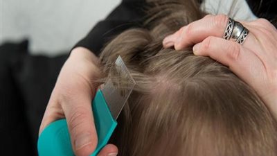 دراسة : القمل انتصر على المستحضرات التي تقاومه