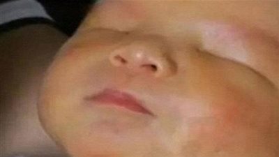 حالة نادرة جداً ..  ولادة طفل بدون عينين!
