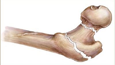 دراسة .. نقص فيتامين 