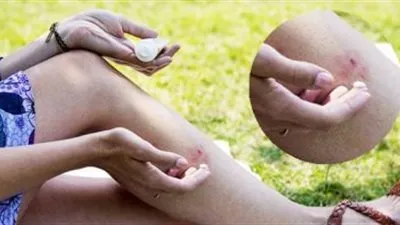 وصفة طبيعية للتخلص من آثار لدغات البعوض