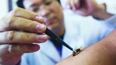 ما حكم الشرع في التداوي بلسع النحل؟