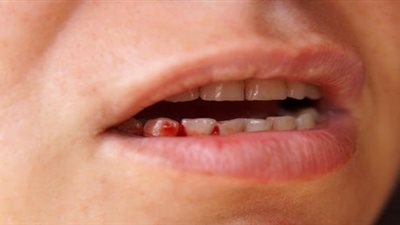 على ماذا يدل نزيف اللثة أثناء تنظيف الأسنان؟