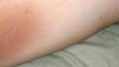 السمنة واضطراب الهرمونات هما أسباب إسمرار منطقة ما بين الفخذين