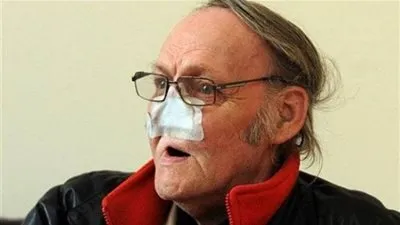 رجل أجري عملية لاستئصال الكتلة السرطانية .. فخرج رجلاً مشوّهاً دون أنف! (صور)