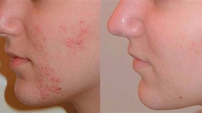 7 أعشاب طبيعية تخلصك من حب الشباب 