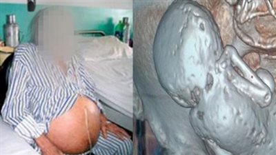 اكتشاف جنينا عمره 35 سنة في بطن عجوز  