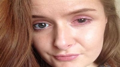 فتاة إنجليزية اقتلعت قرنية عينها.. والسبب العدسات اللاصقة!