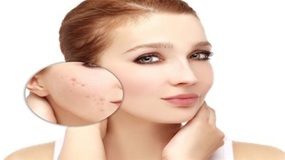 8 وصفات سحرية للتخلص من حبّ الشباب