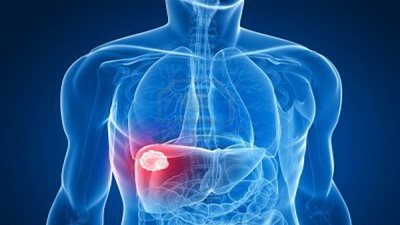 وصفة طبيعية لتنشيط الكبد وتقوية الجهاز المناعي!