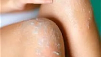 أهم فائد اللبن البودرة لتبييض الوجه والركب الداكنة