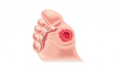 الغرغرينا.. أسبابها طرق علاجها!