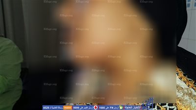 تفاصيل إجراء أول عملية بمصر لاسئصال غدة الدرقية بالمنظار بالأورام جامعة المنصورة