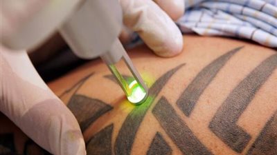 تعرف على طرق إزالة الوشم