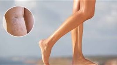 تعرفي على  أهم ما يخلصك من الأوردة  العنكبوتية !