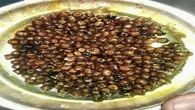 طبيب يُخرج 475 حصاة من مرارة سيدة مصرية