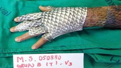 دراسة.. قشر السمك البلطي لعلاج الحروق المستعصية