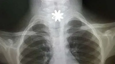 العثور على قطعة من الذهب في مريء طفلة