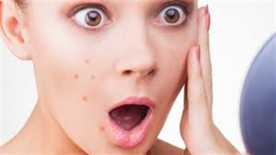 أنواع مرض حب الشباب وطرق العلاج الطبية !