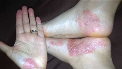 التوتر العصبي يُشعل نوبات الصدفية !