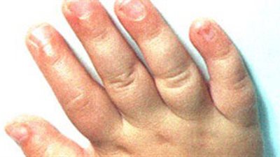 7 أسباب وراء احتباس الماء فى الجسم.. تعرف عليها