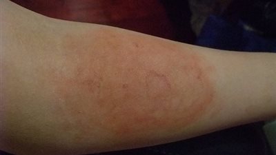 دراسة تنصح بعدم إرتداء ملابس على منطقة الحرق بالجلد