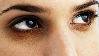 تخلصى من الهالات السوداء باستخدام البطاطس والشاى والحليب