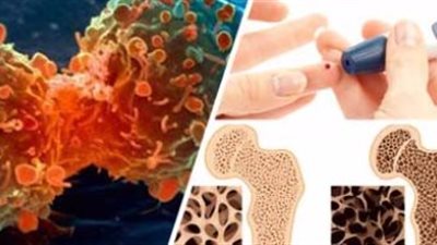 دراسة بريطانية: مرضى الفصام أكثر عرضة للإصابة بالسكر