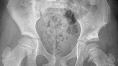 تحذير.. إهمال خلع الورك الولادي يؤدي إلى عجز دائم